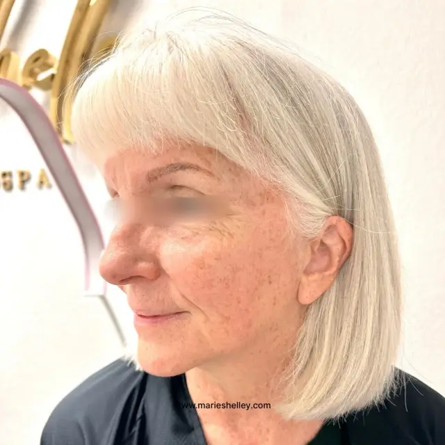 After treatment: a client’s face in profile, with fewer brown spots on the cheek.