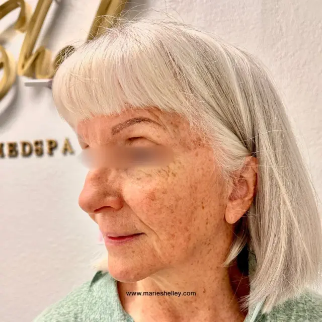 Before treatment: a client’s face in profile.