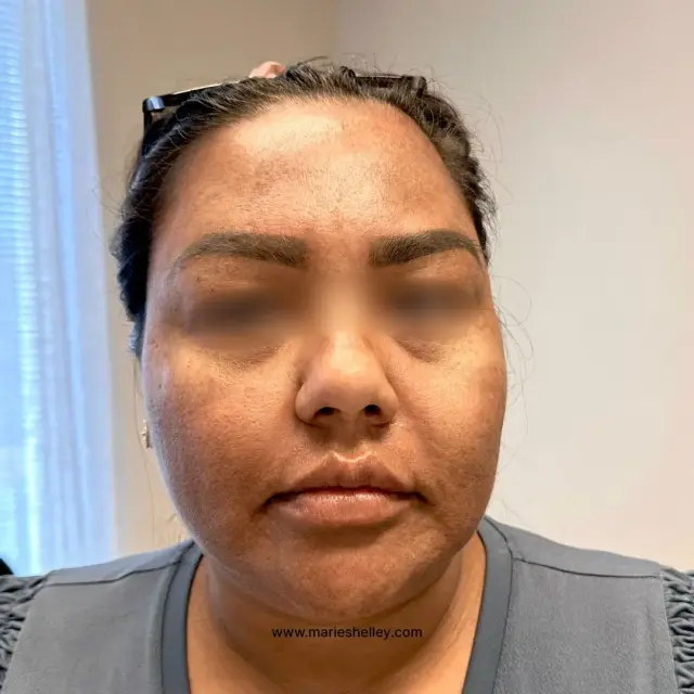 After treatment: a client’s face, front on, with lighter, more even tone.
