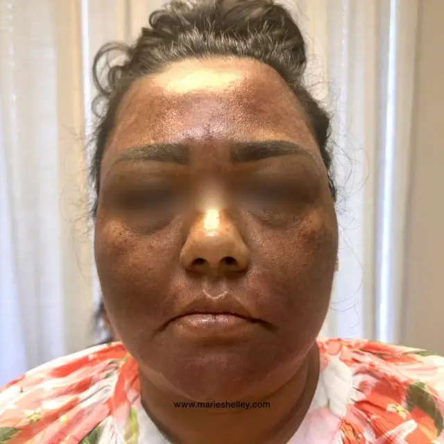 Before treatment: a client’s face, front on.