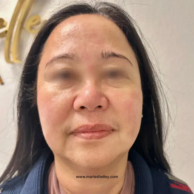 After treatment: a client’s face, front on, with less redness across the cheeks.