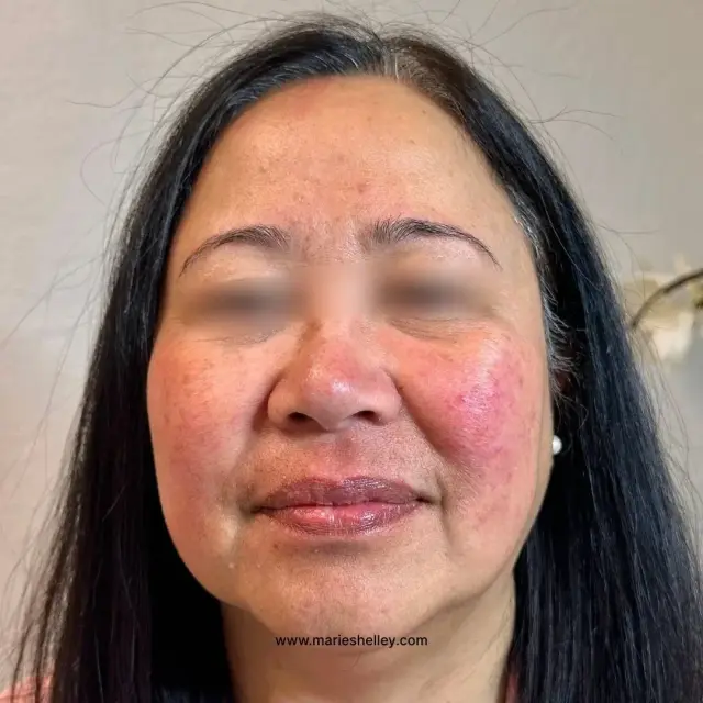 Before treatment: a client’s face, front on.