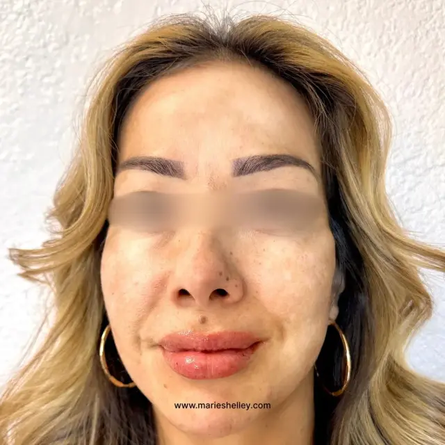 After treatment: a client’s face, front on, with the dark patches on the forehead and cheeks faded.