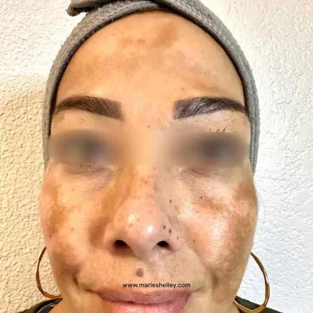Before treatment: a client’s face, front on.